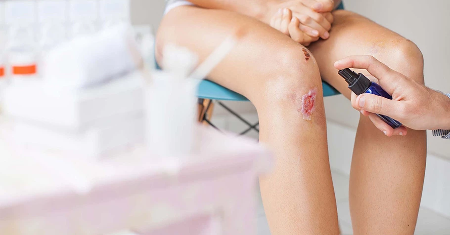 Cách không để lại sẹo khi bị té xe